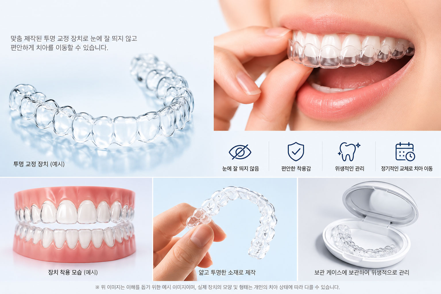 시청역 투명교정 강북센트럴치과 – 투명 교정 장치(가철식 클리어 얼라이너) 이미지