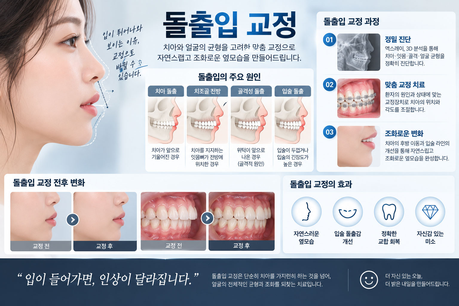 광화문 돌출입교정 강북센트럴치과 – 돌출입 원인별 교정