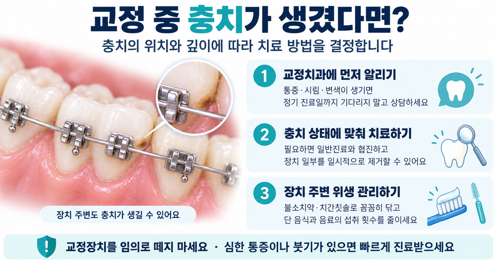시청역 교정 충치 — 브라켓 주변에 치면세균막이 정체되어 법랑질 탈회가 시작되는 과정을 단계별로 정리한 강북센트럴치과 안내 이미지