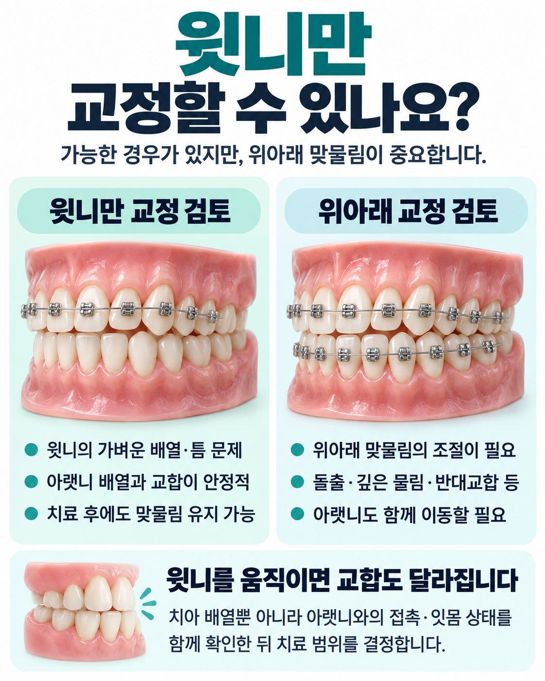 시청역 윗니 교정 검토 기준 비교 — 윗니만 교정하는 경우와 위아래를 함께 교정하는 경우의 판단 조건을 치아 모형으로 정리한 강북센트럴치과 안내 이미지